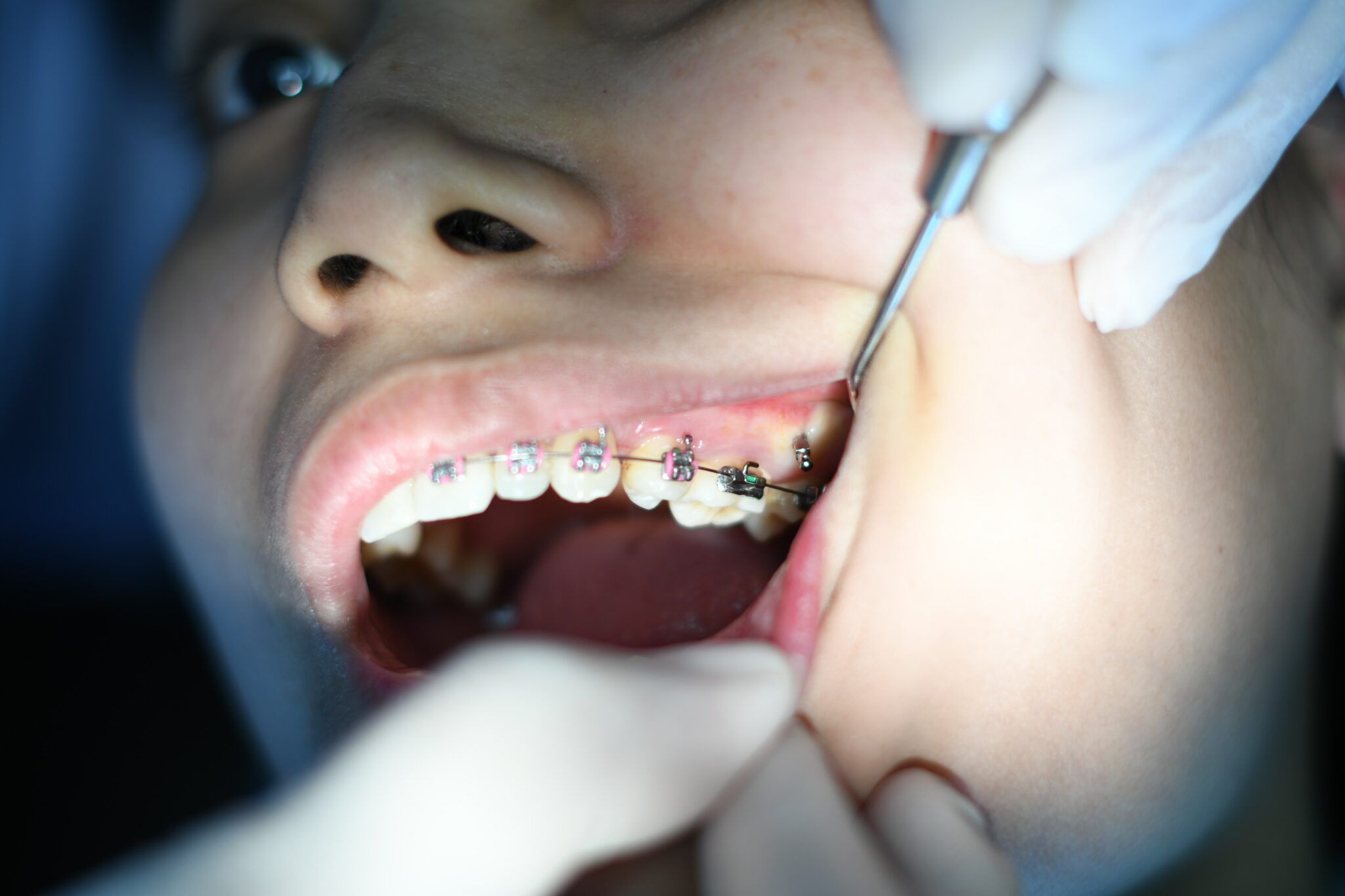 Help! My braces are broken. - Mehta Orthodontics