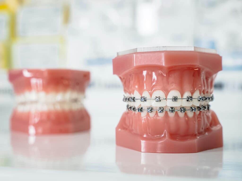 Orthodontic Treatment Myths