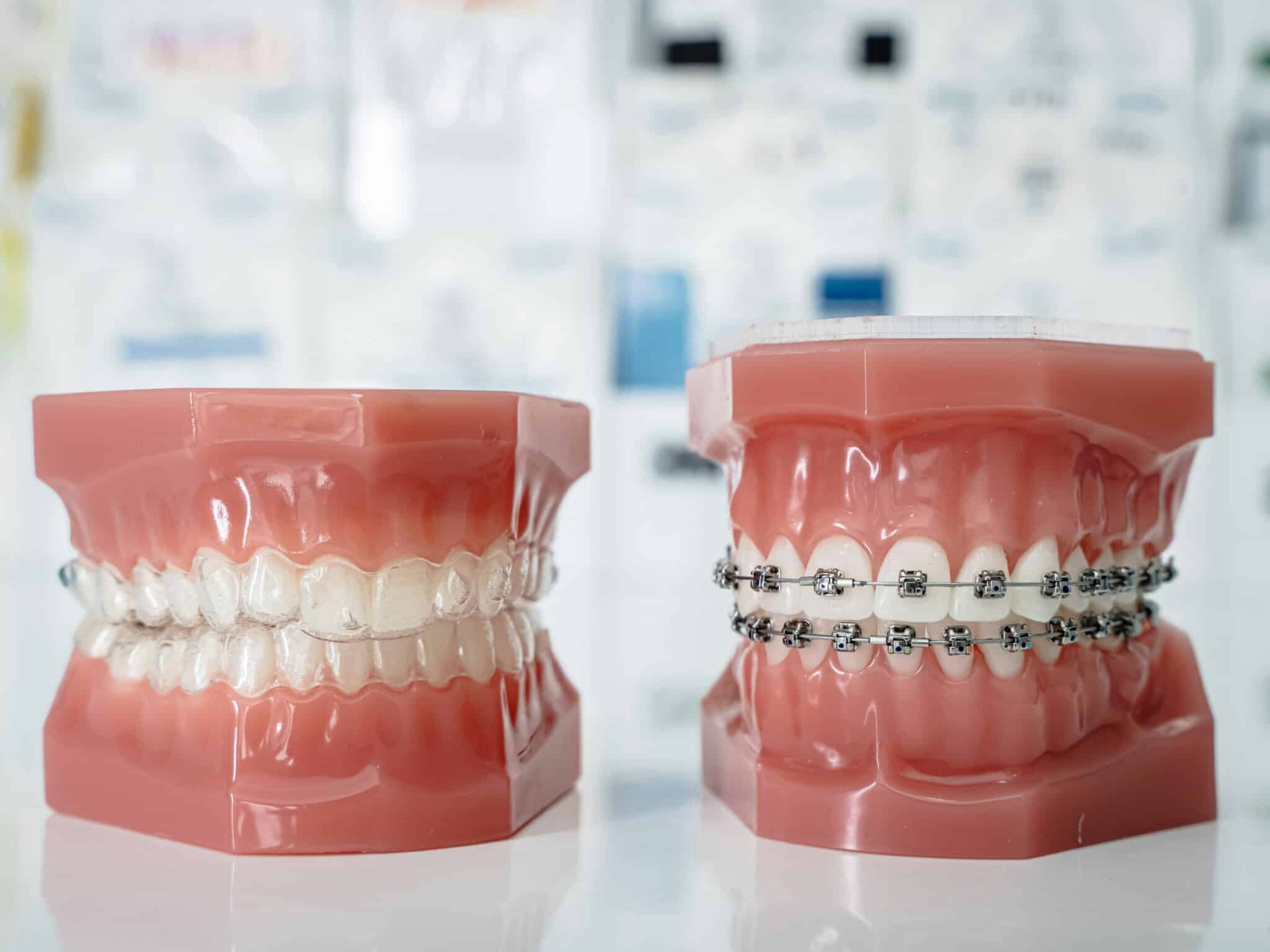 From Expanders to Headgear: Breaking Down Orthodontic Appliances