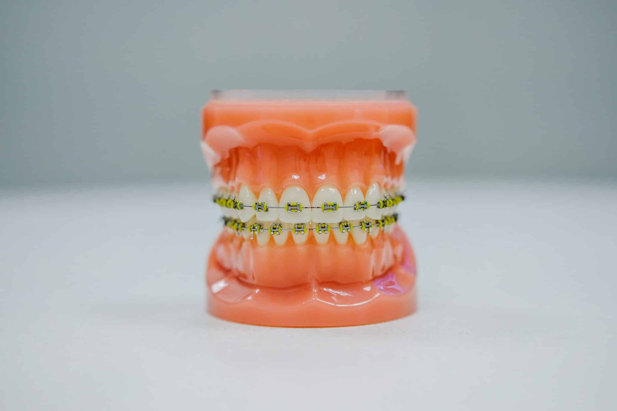 Underbite Treatment: Are Braces Enough or Is Surgery Needed?